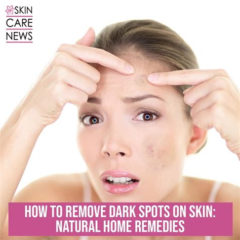 How To Remove Dark spots On Skin: Natural Home Remedies - Skin Care Top News