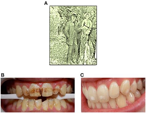 Fluoride Toothpaste Side Effects