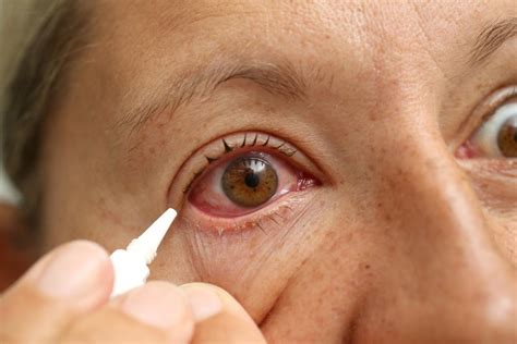 Red eyes: Home remedies and health tips