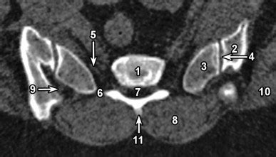 Sacral Foramina Xray