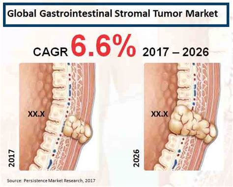 Global Gastrointestinal Stromal Tumor Market: Industry Analysis, Size ...