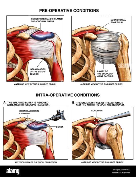 Shoulder Joint Bursitis