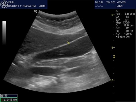 Acute Cholecystitis ~ Ultrasound Cases Info