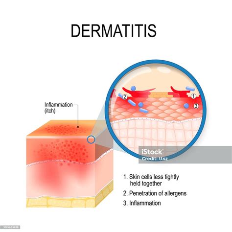 Atopic Dermatitis Stock Illustration - Download Image Now - Atopic Eczema, Scratching, Skin - iStock