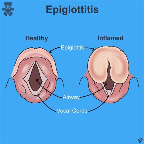 Epiglottitis - TeachMePaediatrics