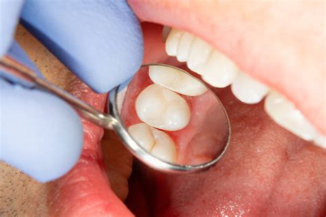 How Often do You Need Dental Sealants? | Dental Sealants Pomona