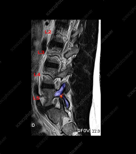 MRI of L5 Spondylolysis - Stock Image - C004/7480 - Science Photo Library