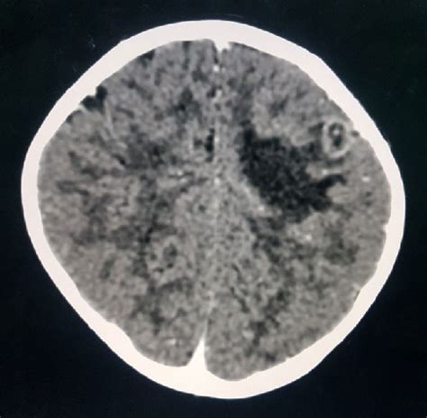 Contrast enhanced CT scan of brain shows ring enhancing lesion in left... | Download Scientific ...