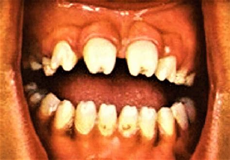 Hutchinson's teeth causes, diagnosis & treatment