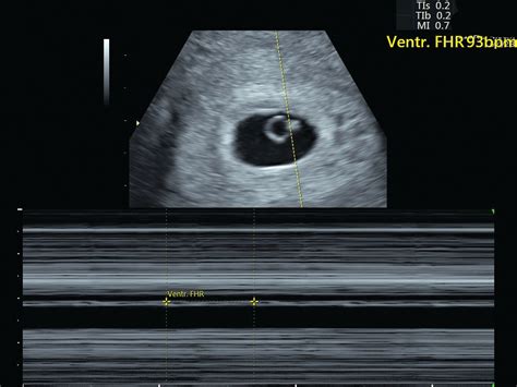 6 Week Ultrasound Heartbeat