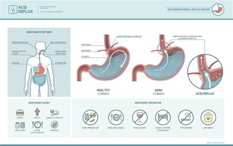 Proton Pump Inhibitor Side Effects | PPI Side Effects