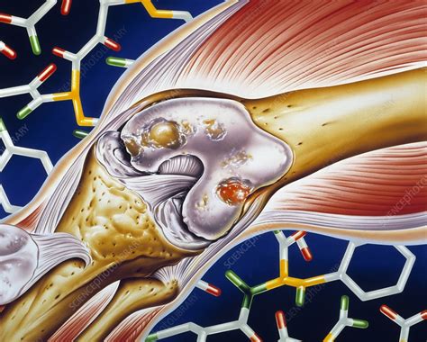 Rheumatoid arthritis of the knee - Stock Image - M110/0526 - Science Photo Library