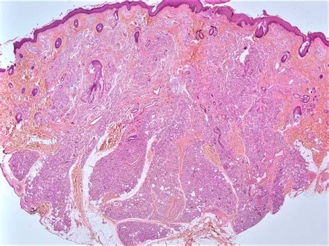 Skin Hemangioma Histology