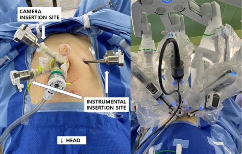 Referenzen Diskretion Das Layout robotic laparoscopic myomectomy Sinn Paar Entsorgt