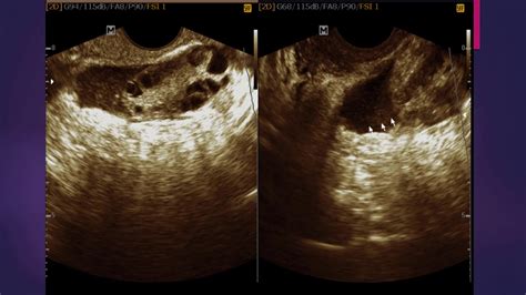 Nabothian Cyst In Cervix Ultrasound