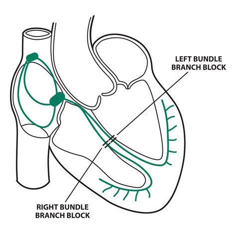 Bundle Branch Blocks (Part 1 – Left and Right Bundle Branch Blocks) - Medical Exam Prep