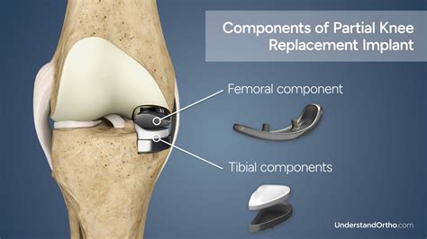 Partial Knee Replacement – UnderstandOrtho™