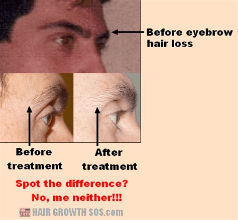 What Causes Eyebrow Hair Loss? How Do You Treat it?