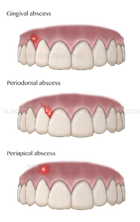 Dental abscess