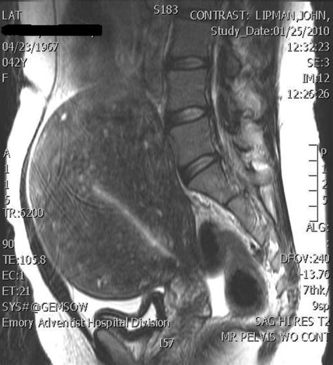 Imaging with MRI - Why You Need an MRI to Detect Fibroids