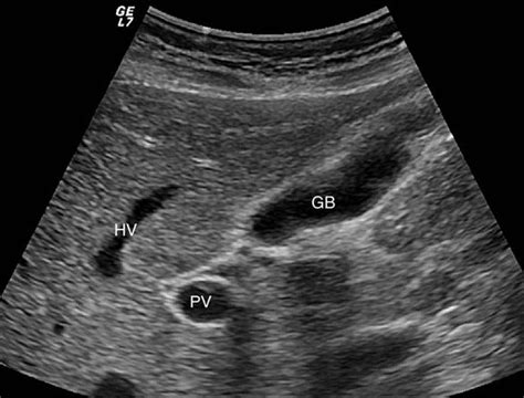 Hepatobiliary Ultrasound | Radiology Key