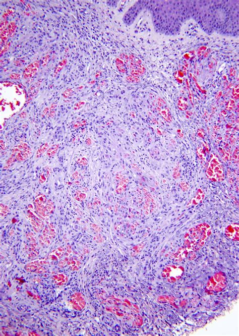 Kaposi Sarcoma Histology