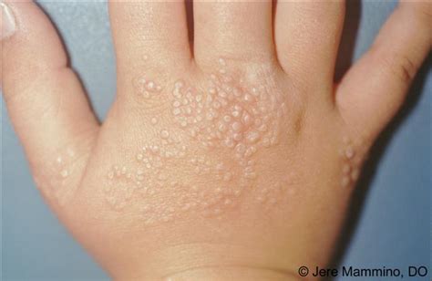 Lichen Nitidus - American Osteopathic College of Dermatology (AOCD)