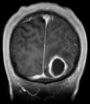 Coronal MRI image showing ring-enhancing lesion | Download Scientific Diagram