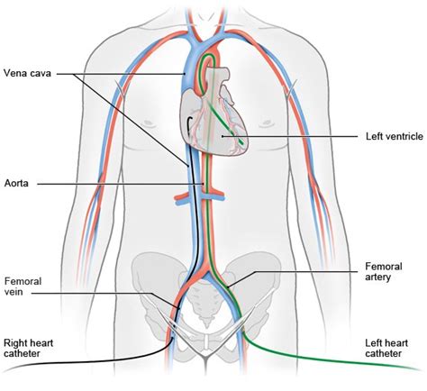 What happens during cardiac catheterization? | informedhealth.org