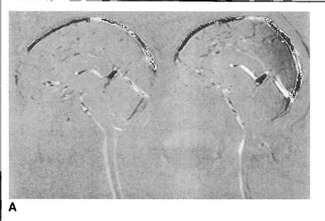 Figure 1 from Motion of the cerebellar tonsils in Chiari type I malformation studied by cine ...