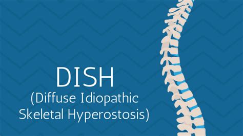 Dish (Diffuse Idiopathic Skeletal Hyperostosis)