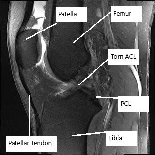 Mri Knee Acl Tear