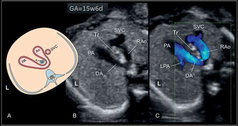 Right Aortic Arch, Double Aortic Arch, and Aberrant Subclavian Artery ...