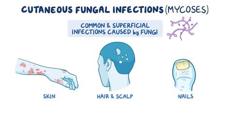 Dermatophyte Infection: What Is It, Causes, Signs And