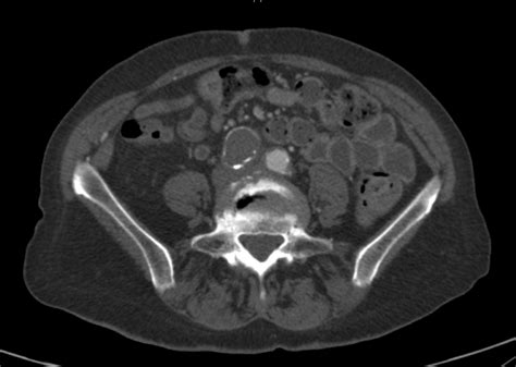 Iliac Artery Aneurysm: Symptoms, Diagnosis and Treatment