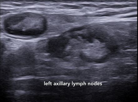 Swollen Lymph Nodes Armpit Ultrasound