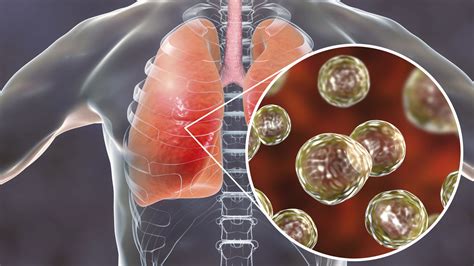 4 key things to know about lung infections caused by fungi - Digital News
