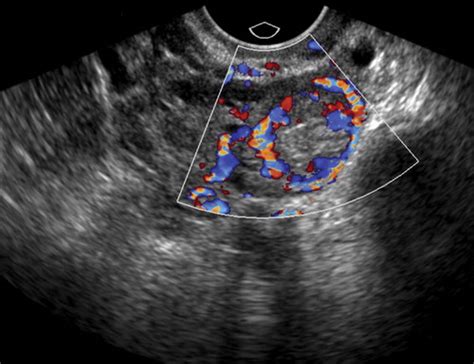 Decidual Reaction Ultrasound