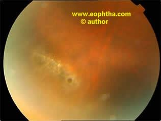 Atrophic Retinal Hole