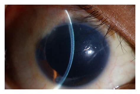 Clinical picture on presentation showing corneal edema, peripheral... | Download Scientific Diagram