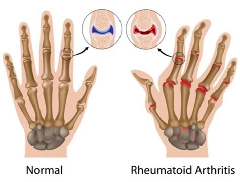 Rheumatoid arthritis - Genetics Home Reference - NIH