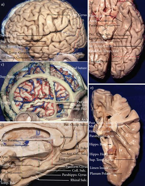 The Temporal Lobe | Neuroanatomy | The Neurosurgical Atlas