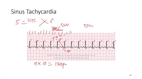 Sinus Tachycardia Vs Supraventricular Tachy