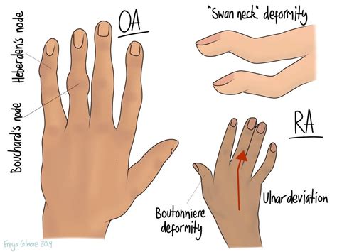 Arthritic Pain - Gemini Osteopathy