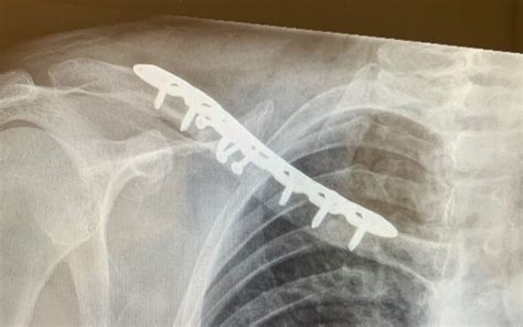 4 Lessons from a Surgeon’s Clavicle Surgery: “The Other Side of the Knife” - Orthopaedic ...