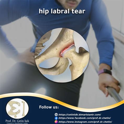 Hip labrum tear; Causes and treatment methods - Dr. What's wrong with you?