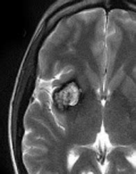 Susceptibility artifact - Questions and Answers in MRI