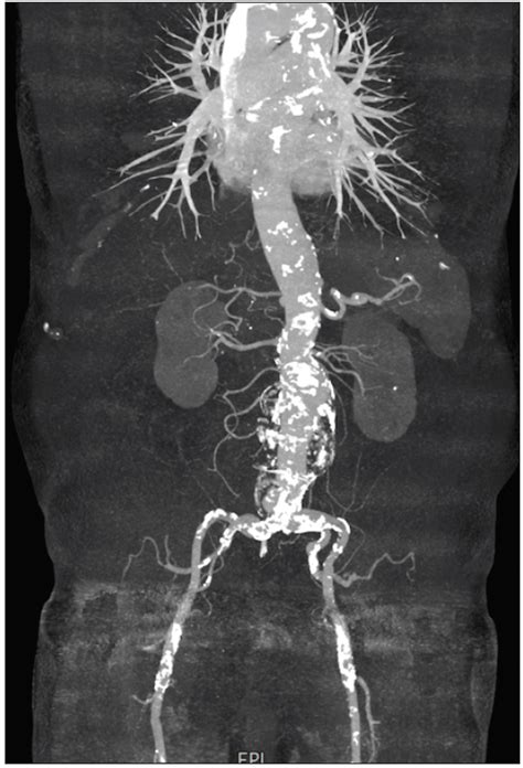 Case Report: Treatment of a Juxtarenal Aortic Aneurysm With a Relay®Plus Stent Graft and a ...