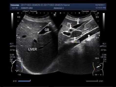 Porta Hepatis Ultrasound