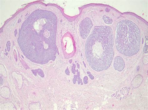 BCC - Basal Cell Carcinoma - Dr Marshall Murdoch